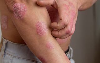 psoriasis treatment holiday